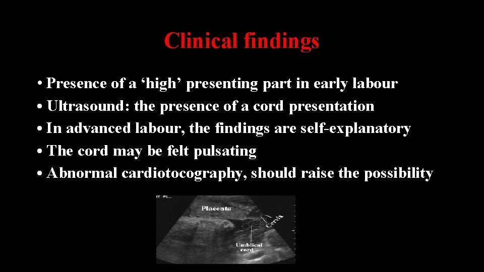 Clinical findings • Presence of a ‘high’ presenting part in early labour • Ultrasound:
