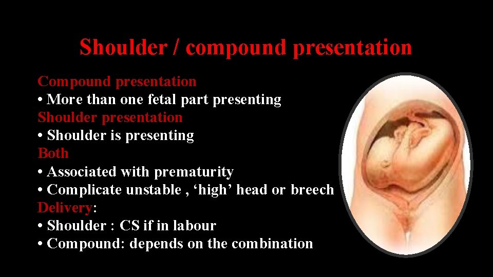 Shoulder / compound presentation Compound presentation • More than one fetal part presenting Shoulder