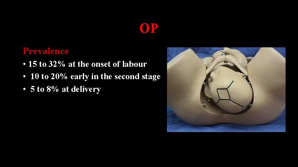 OP Prevalence • 15 to 32% at the onset of labour • 10 to