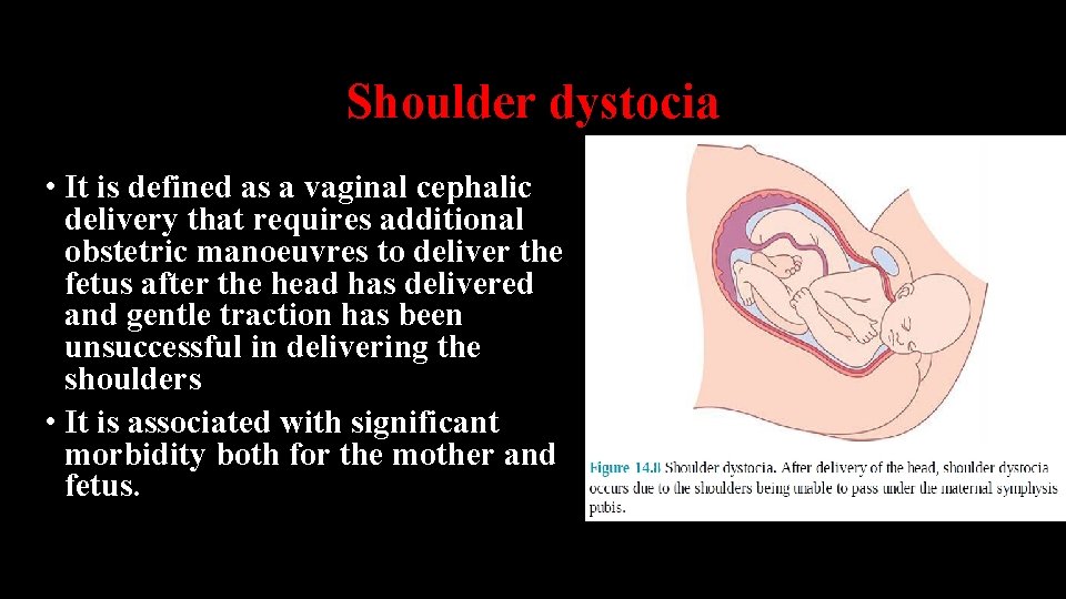 Shoulder dystocia • It is defined as a vaginal cephalic delivery that requires additional
