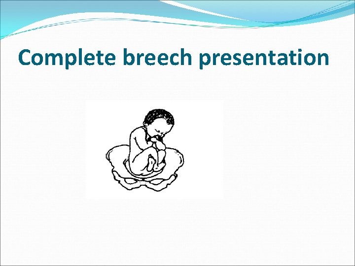 Complete breech presentation 