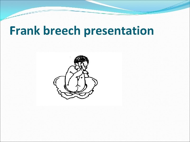 Frank breech presentation 