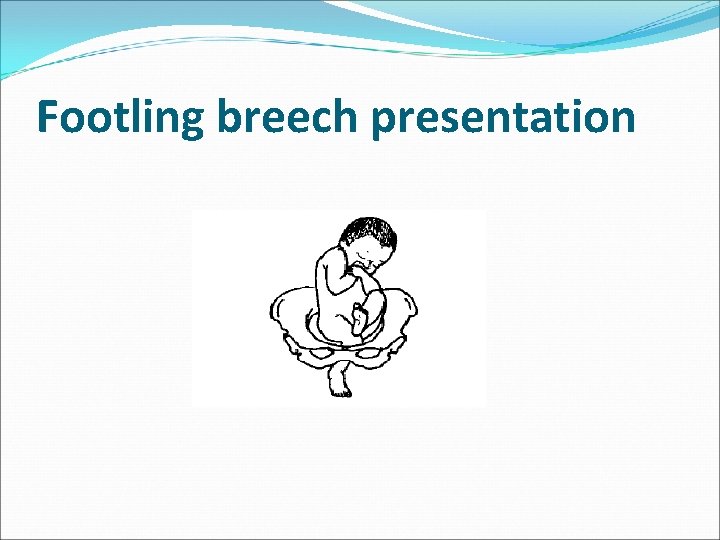 Footling breech presentation 