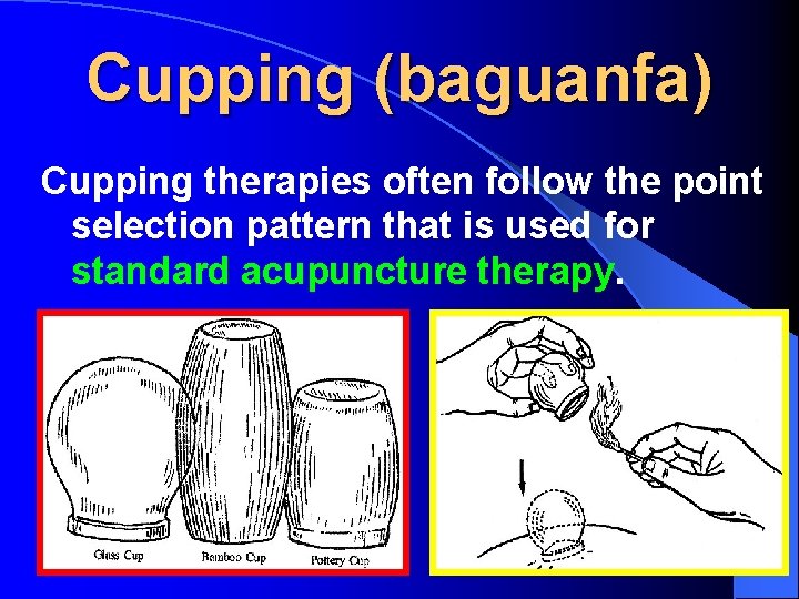 Cupping (baguanfa) Cupping therapies often follow the point selection pattern that is used for
