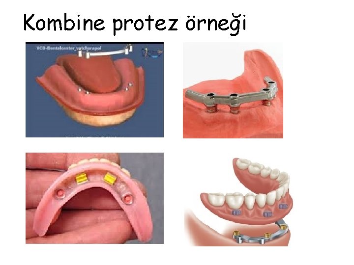 Kombine protez örneği 