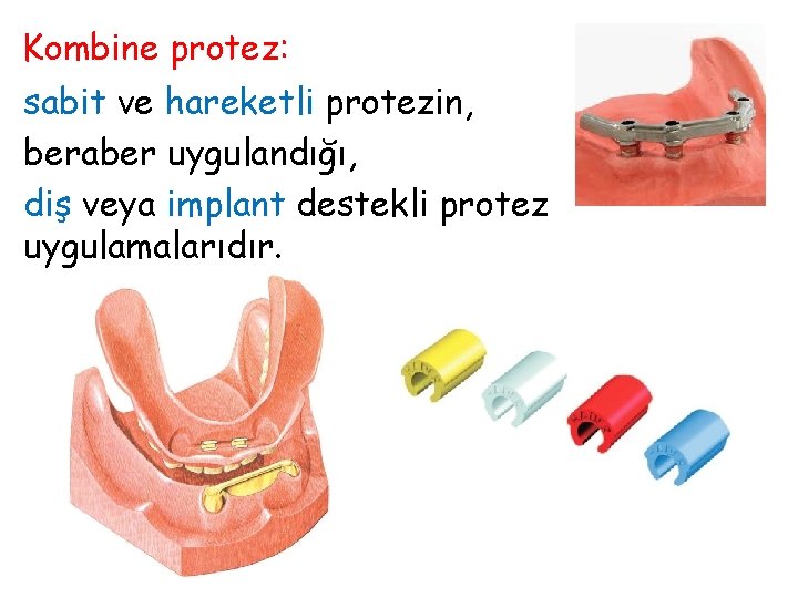 Kombine protez: sabit ve hareketli protezin, beraber uygulandığı, diş veya implant destekli protez uygulamalarıdır.