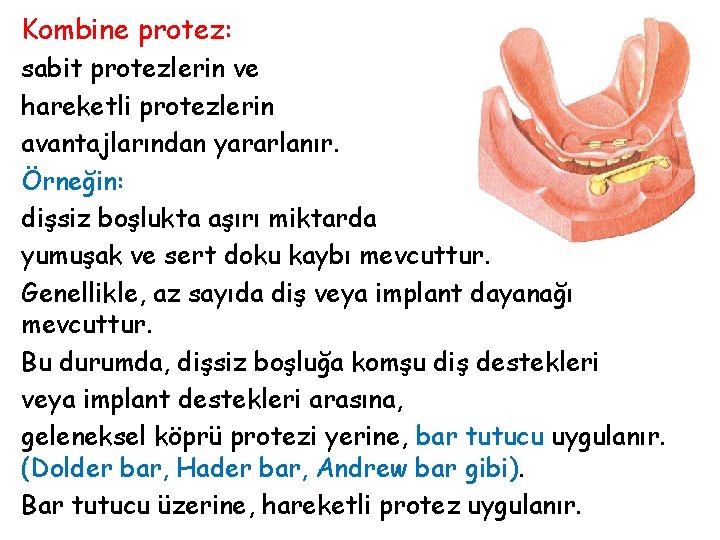 Kombine protez: sabit protezlerin ve hareketli protezlerin avantajlarından yararlanır. Örneğin: dişsiz boşlukta aşırı miktarda