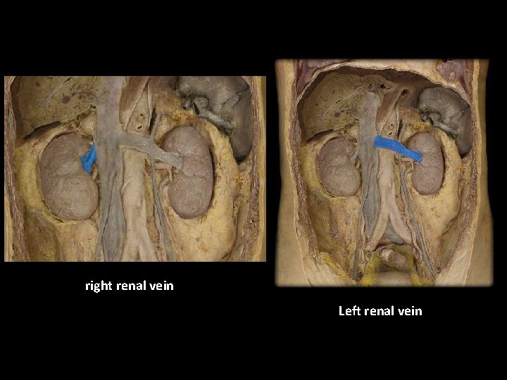 right renal vein Left renal vein 