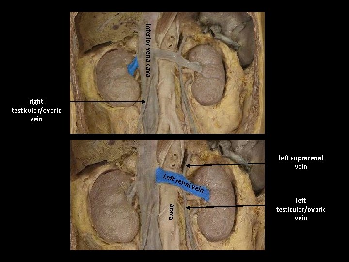 Inferior vena cava right testicular/ovaric vein Left left suprarenal vein rena l ve in