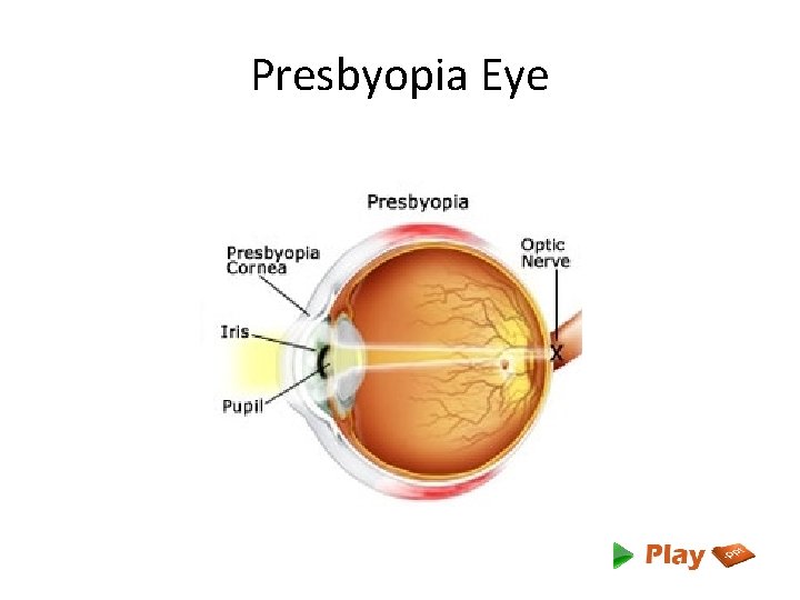 Presbyopia Eye 