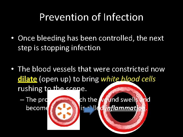 Prevention of Infection • Once bleeding has been controlled, the next step is stopping