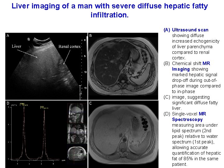 Liver imaging of a man with severe diffuse hepatic fatty infiltration. (A) Ultrasound scan