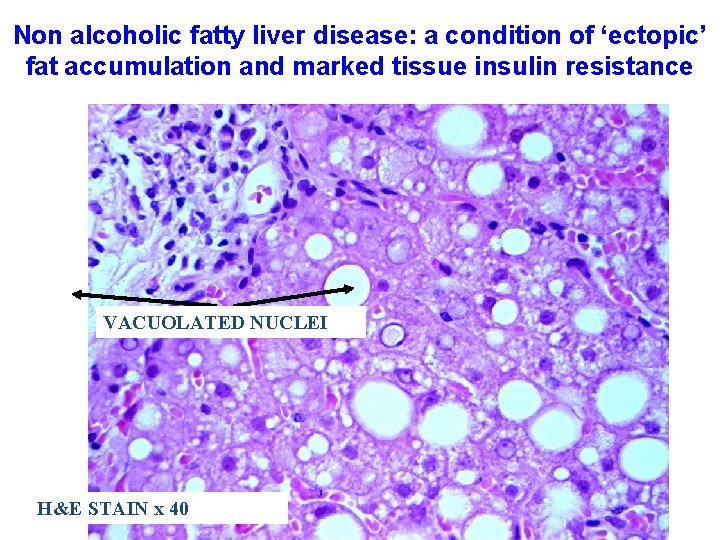 Non alcoholic fatty liver disease: a condition of ‘ectopic’ fat accumulation and marked tissue