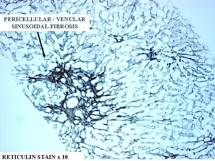 PERICELLULAR / VENULAR SINUSOIDAL FIBROSIS RETICULIN STAIN x 10 