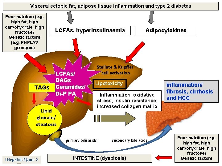 Visceral ectopic fat, adipose tissue inflammation and type 2 diabetes Poor nutrition (e. g.