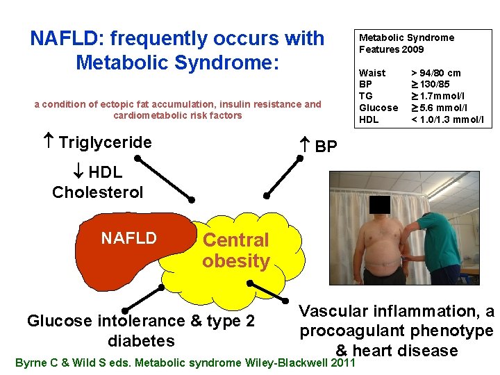 NAFLD: frequently occurs with Metabolic Syndrome: a condition of ectopic fat accumulation, insulin resistance