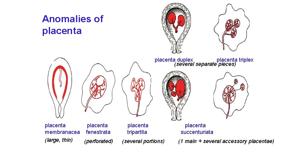 Anomálie placenty Anomalies of placenta duplex placenta triplex (several separate pieces) placenta membranacea fenestrata