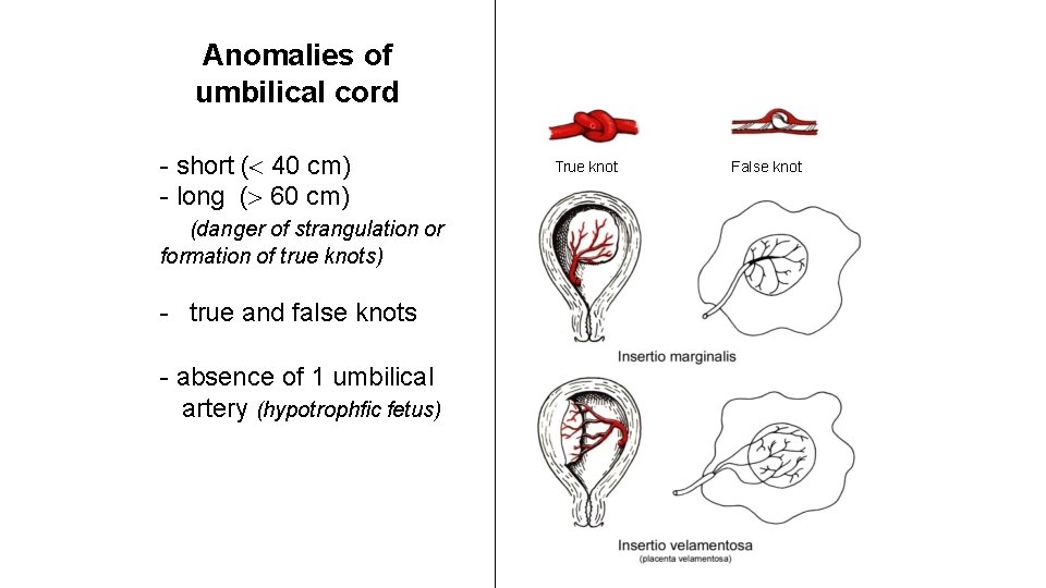 Anomalies of umbilical cord - short ( 40 cm) - long ( 60 cm)