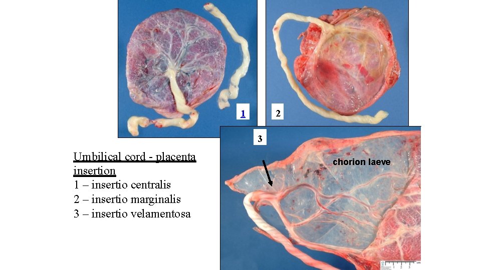 1 2 3 Umbilical cord - placenta insertion 1 – insertio centralis 2 –