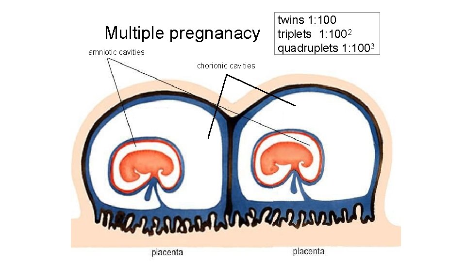 Multiple pregnanacy amniotic cavities chorionic cavities twins 1: 100 triplets 1: 1002 quadruplets 1: