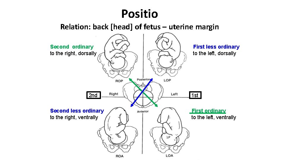 Positio Relation: back [head] of fetus – uterine margin Second ordinary to the right,