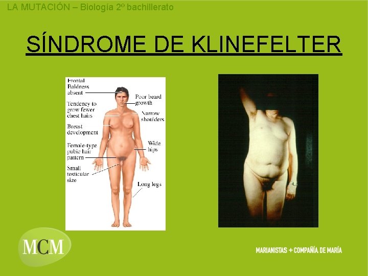 LA MUTACIÓN – Biología 2º bachillerato SÍNDROME DE KLINEFELTER 