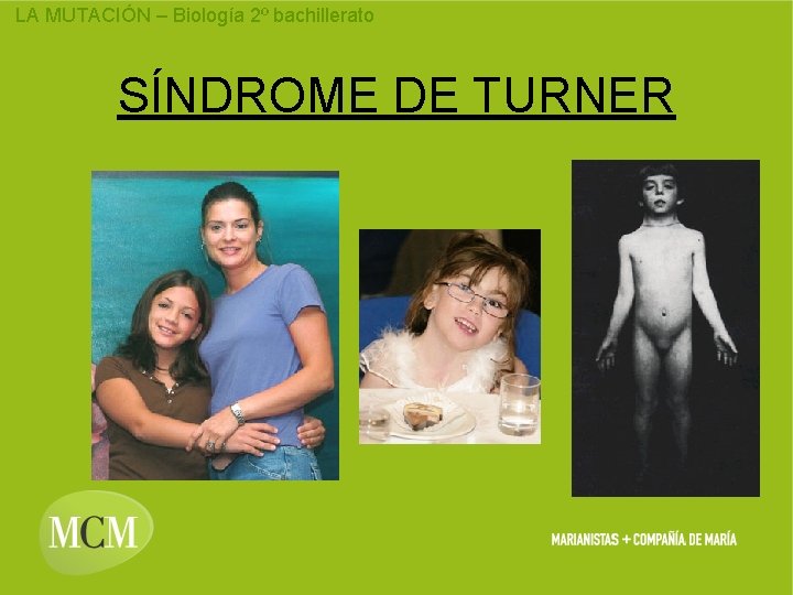 LA MUTACIÓN – Biología 2º bachillerato SÍNDROME DE TURNER 