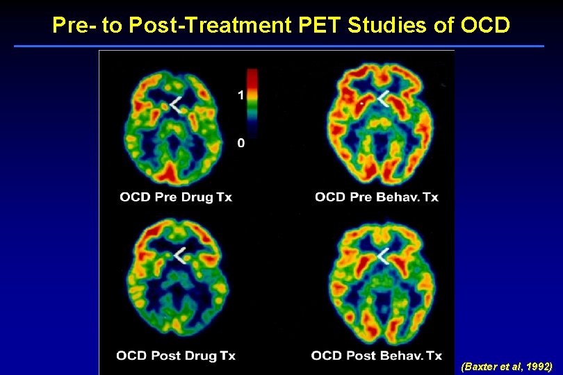 Pre- to Post-Treatment PET Studies of OCD (Baxter et al, 1992) 