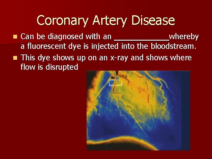 Coronary Artery Disease Can be diagnosed with an _____ _whereby a fluorescent dye is