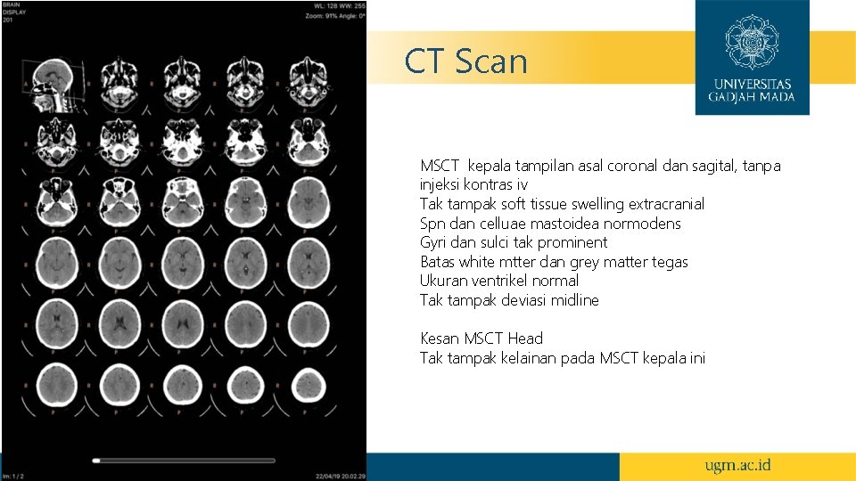 CT Scan MSCT kepala tampilan asal coronal dan sagital, tanpa injeksi kontras iv Tak