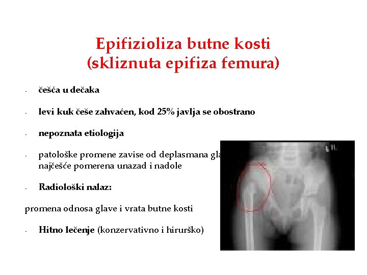 Epifizioliza butne kosti (skliznuta epifiza femura) • češća u dečaka • levi kuk češe