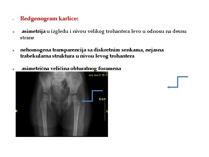  • Ø Ø Ø Redgenogram karlice: asimetrija u izgledu i nivou velikog trohantera