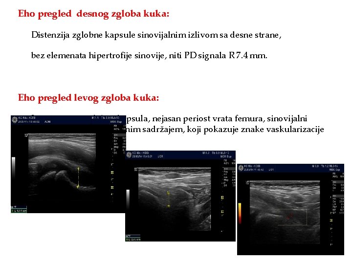 Eho pregled desnog zgloba kuka: Distenzija zglobne kapsule sinovijalnim izlivom sa desne strane, bez