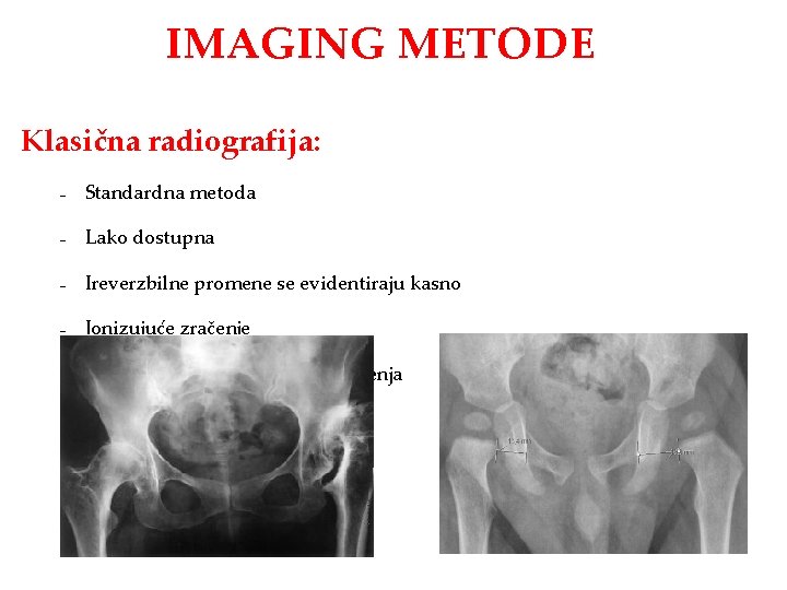 IMAGING METODE Klasična radiografija: – Standardna metoda – Lako dostupna – Ireverzbilne promene se