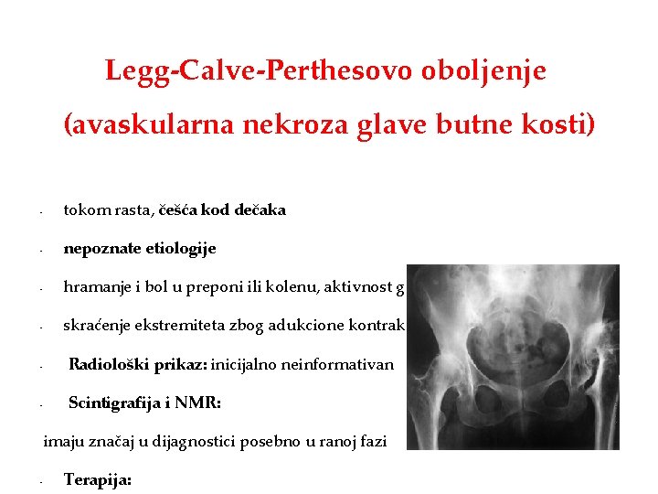 Legg-Calve-Perthesovo oboljenje (avaskularna nekroza glave butne kosti) • tokom rasta, češća kod dečaka •