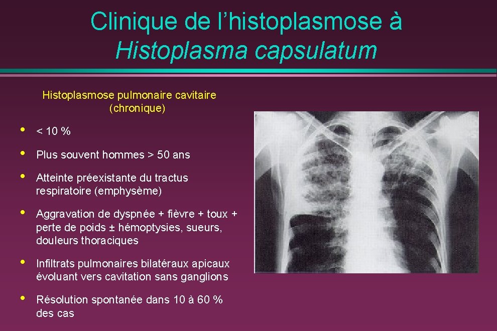 Clinique de l’histoplasmose à Histoplasma capsulatum Histoplasmose pulmonaire cavitaire (chronique) • • • <