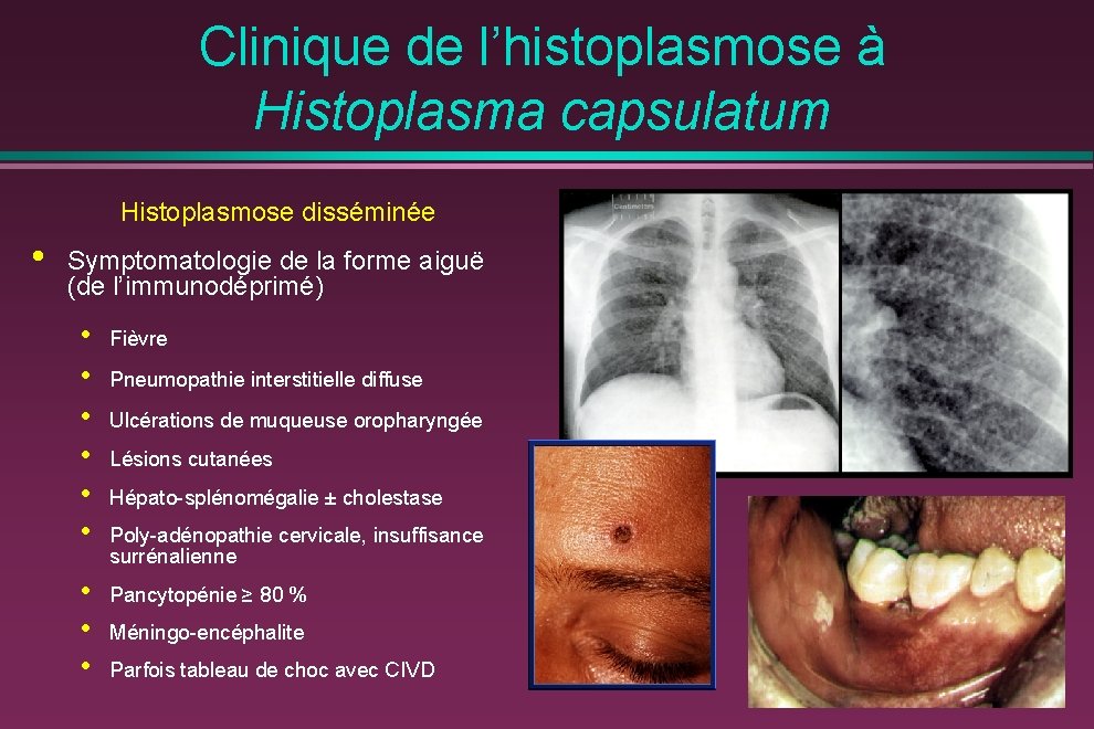 Clinique de l’histoplasmose à Histoplasma capsulatum Histoplasmose disséminée • Symptomatologie de la forme aiguë