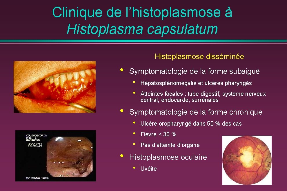 Clinique de l’histoplasmose à Histoplasma capsulatum Histoplasmose disséminée • Symptomatologie de la forme subaiguë