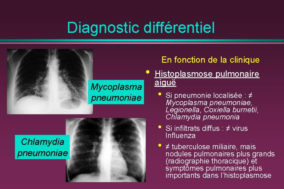 Diagnostic différentiel En fonction de la clinique • Mycoplasma pneumoniae Histoplasmose pulmonaire aiguë •