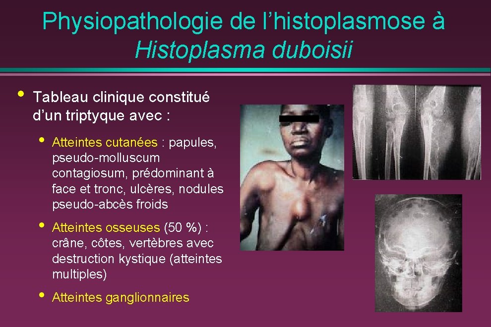 Physiopathologie de l’histoplasmose à Histoplasma duboisii • Tableau clinique constitué d’un triptyque avec :