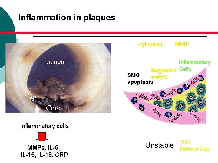 Inflammation in plaques cytokines Lumen MMP Inflammatory Degraded Cells SMC matrix apoptosis Cap Core