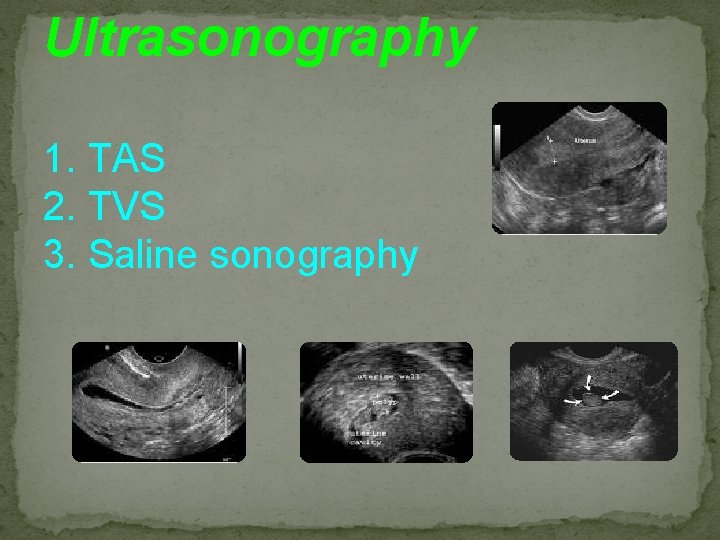 Ultrasonography 1. TAS 2. TVS 3. Saline sonography 