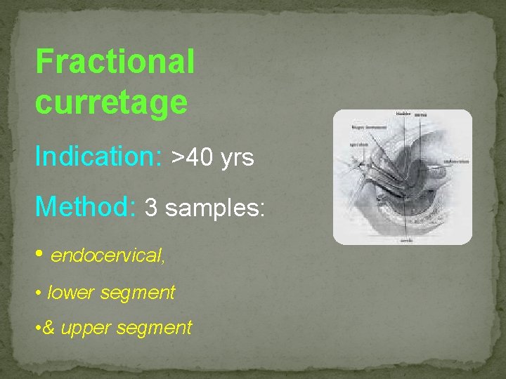 Fractional curretage Indication: >40 yrs Method: 3 samples: • endocervical, • lower segment •