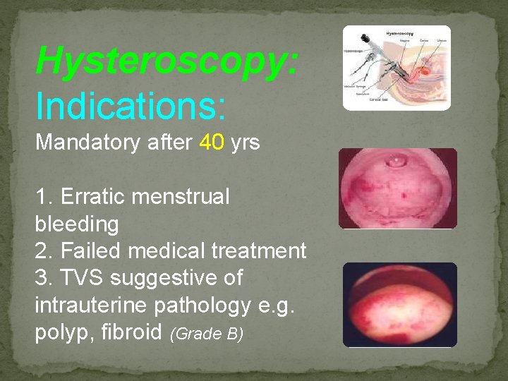 Hysteroscopy: Indications: Mandatory after 40 yrs 1. Erratic menstrual bleeding 2. Failed medical treatment