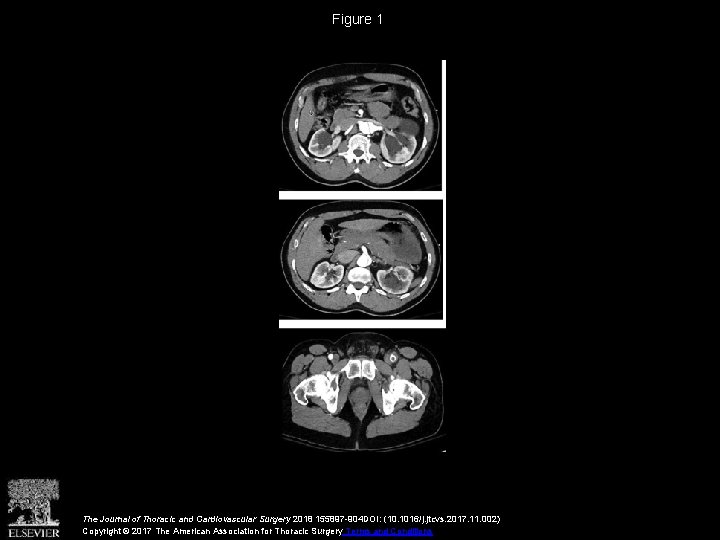 Figure 1 The Journal of Thoracic and Cardiovascular Surgery 2018 155897 -904 DOI: (10.