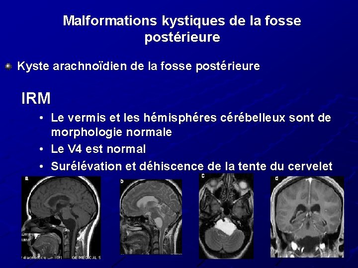 Malformations kystiques de la fosse postérieure Kyste arachnoïdien de la fosse postérieure IRM •