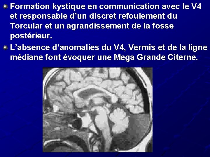 Formation kystique en communication avec le V 4 et responsable d’un discret refoulement du Formation kystique en communication avec le V 4 et responsable d’un discret refoulement du