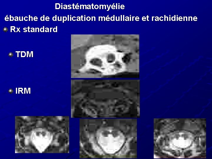 Diastématomyélie ébauche de duplication médullaire et rachidienne Rx standard TDM IRM Diastématomyélie ébauche de duplication médullaire et rachidienne Rx standard TDM IRM