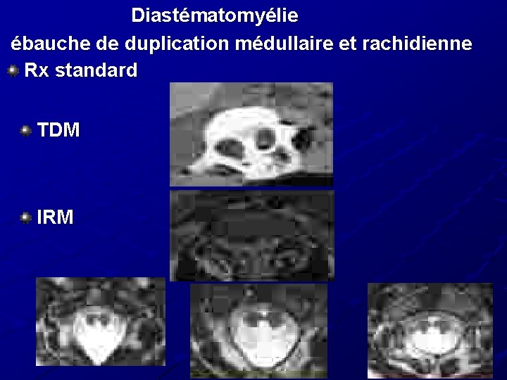 Diastématomyélie ébauche de duplication médullaire et rachidienne Rx standard TDM IRM 