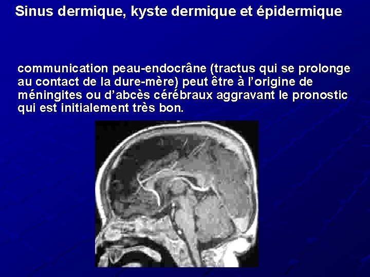 Sinus dermique, kyste dermique et épidermique communication peau-endocrâne (tractus qui se prolonge au contact Sinus dermique, kyste dermique et épidermique communication peau-endocrâne (tractus qui se prolonge au contact
